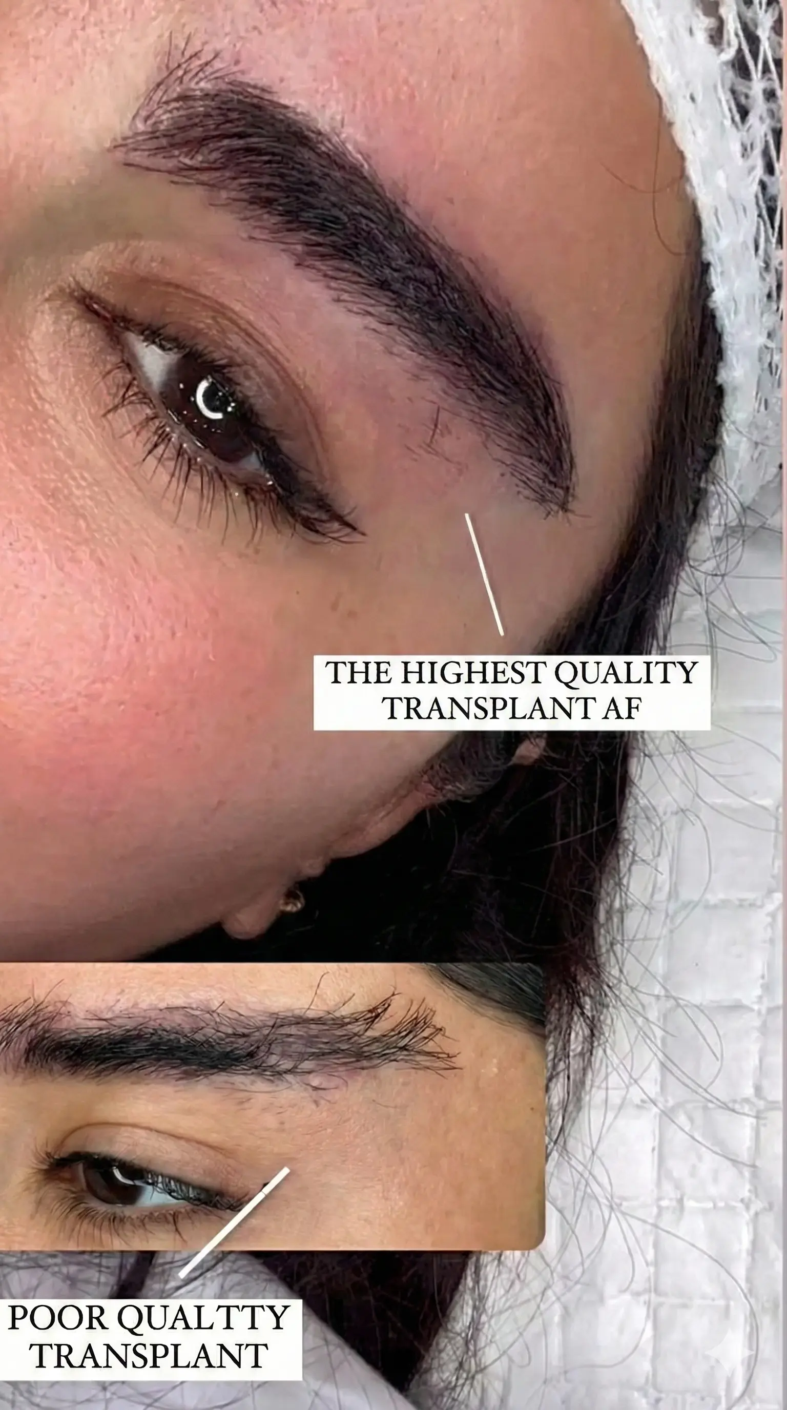 Comparison between FUE and AF transplant methods